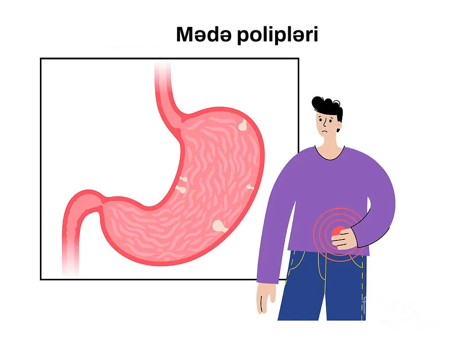 mədə polipləri